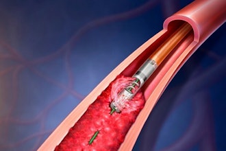 Rotarex Thrombectmy (1)