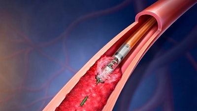 Rotarex Thrombectmy (1)