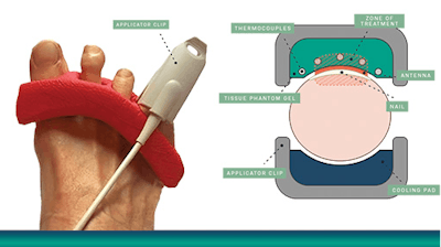 BiaCure's Onychomycosis treatment.
