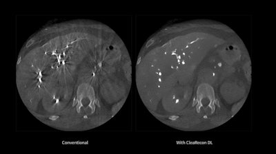 CleaRecon DL versus conventional imaging.