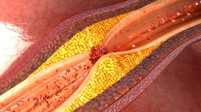 A clogged artery due to plaque build-up.