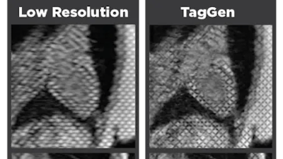 Low Res 25 0812 Sm Heart Mri Scan Comparison 03