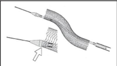 Vascular Stent