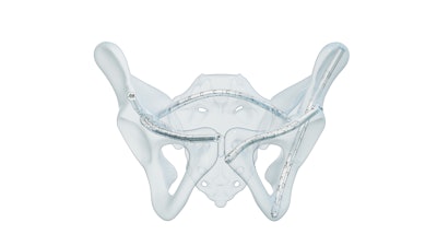 Five Curva Fix Implants In Pelvis