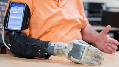 A study participant with upper-limb loss using the CWRU-developed sensory-enabled neural-controlled iSens prosthesis. Implanted electrodes capture muscle movement in the remaining arm to control the hand and send sensory information from the fingertips to the nerves.