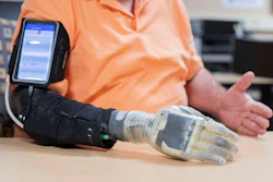 A study participant with upper-limb loss using the CWRU-developed sensory-enabled neural-controlled iSens prosthesis. Implanted electrodes capture muscle movement in the remaining arm to control the hand and send sensory information from the fingertips to the nerves.