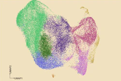 A UMAP graphical depiction of 45,963 cancer cells from patients whose chronic lymphocytic leukemia has transformed into a more aggressive type. The different colors represent different cell states (e.g., light green represents an inflammatory state, hot pink represents proliferating). GoT-Multi linked these cell states with their mutational status to reveal the commonalities in gene activity that lead to treatment resistance.