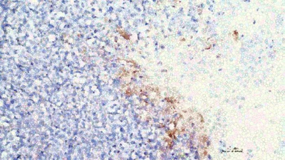 Digitally modified image of tumor cells with CRISPR/Cas9 affected cells in brown.