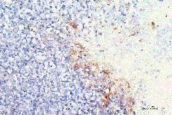 Digitally modified image of tumor cells with CRISPR/Cas9 affected cells in brown.