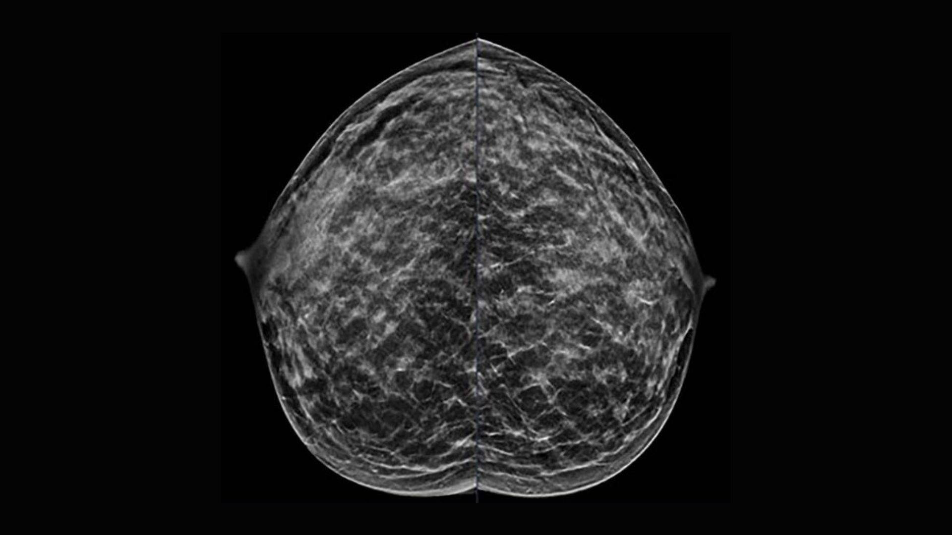 40-year-old patient presents for routine screening. Family history of paternal grandmother age 55. Extremely dense breast tissue is noted on mammography right and left craniocaudal (taken from the top of the breast) view.
