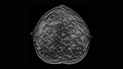 40-year-old patient presents for routine screening. Family history of paternal grandmother age 55. Extremely dense breast tissue is noted on mammography right and left craniocaudal (taken from the top of the breast) view.