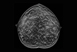 40-year-old patient presents for routine screening. Family history of paternal grandmother age 55. Extremely dense breast tissue is noted on mammography right and left craniocaudal (taken from the top of the breast) view.