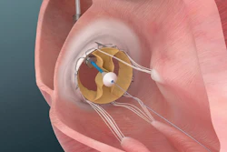 Trisol Valve