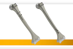 Stryker Launches T2 Alpha Humerus Nailing System