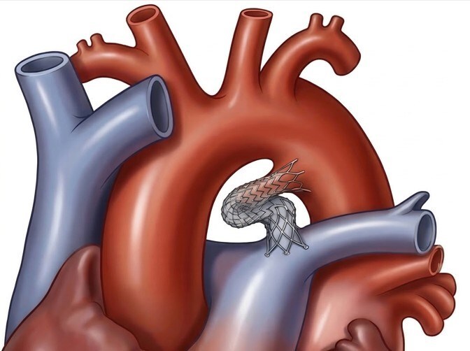 Stent In Ductus