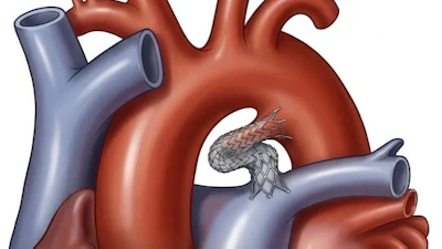 Stent In Ductus
