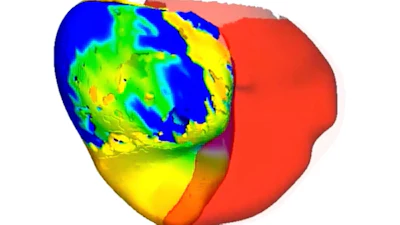 This image from video provided by Johns Hopkins University in March 2026 shows a digital twin of a heart belonging to a patient with an irregular heartbeat being used to simulate treatment approaches.