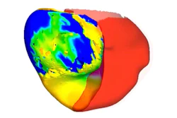 This image from video provided by Johns Hopkins University in March 2026 shows a digital twin of a heart belonging to a patient with an irregular heartbeat being used to simulate treatment approaches.