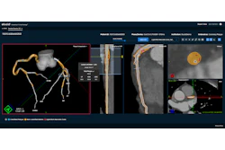 Elucid's new Lesion Inspection Tool for coronary and carotid plaque analysis in its Plaque-IQ software suite provides physicians the ability to interrogate lesion-specific composition and plaque burden across any vessel.
