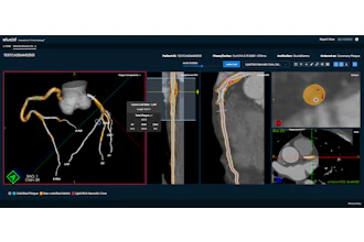 Elucid's new Lesion Inspection Tool for coronary and carotid plaque analysis in its Plaque-IQ software suite provides physicians the ability to interrogate lesion-specific composition and plaque burden across any vessel.