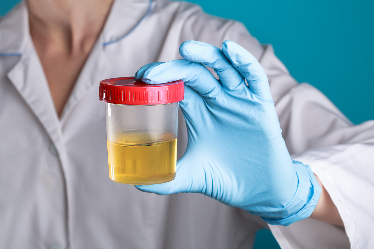 FDA Advances Urine Test That Detects Multiple Forms of Cancer | Medical ...