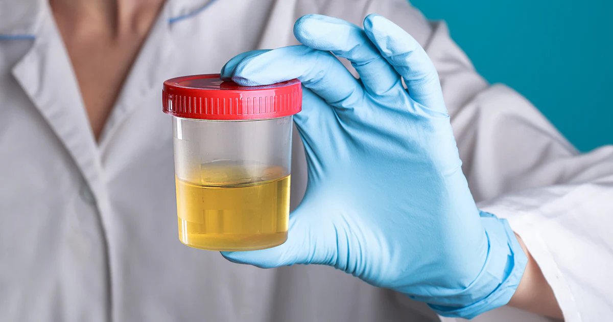 FDA Advances Urine Test That Detects Multiple Forms of Cancer | Medical ...