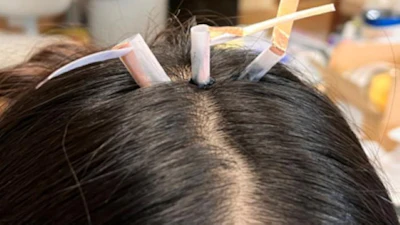 EEG electrodes are placed through hair during testing of a biogel designed by Penn State researchers to improve contact with the scalp for wearable brain-monitoring systems. The reusable material softens with gentle heat, reaches the skin and gels again as it cools.