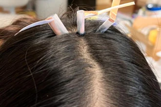 EEG electrodes are placed through hair during testing of a biogel designed by Penn State researchers to improve contact with the scalp for wearable brain-monitoring systems. The reusable material softens with gentle heat, reaches the skin and gels again as it cools.