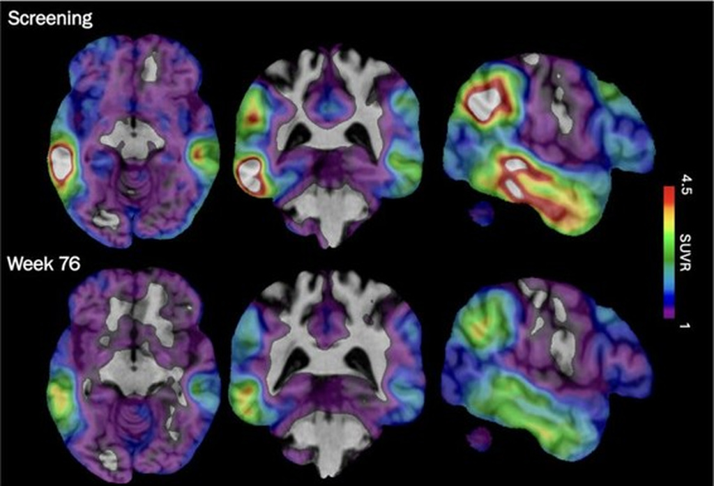 These brain scan images provided by Biogen show how high levels of Alzheimer's-related tau protein, in red, dropped in a recipient of the company's experimental drug diranersen.