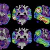 These brain scan images provided by Biogen show how high levels of Alzheimer's-related tau protein, in red, dropped in a recipient of the company's experimental drug diranersen.
