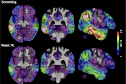 These brain scan images provided by Biogen show how high levels of Alzheimer's-related tau protein, in red, dropped in a recipient of the company's experimental drug diranersen.