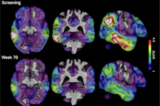 These brain scan images provided by Biogen show how high levels of Alzheimer's-related tau protein, in red, dropped in a recipient of the company's experimental drug diranersen.
