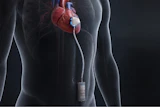 An ITEN battery in an implantable medical device.