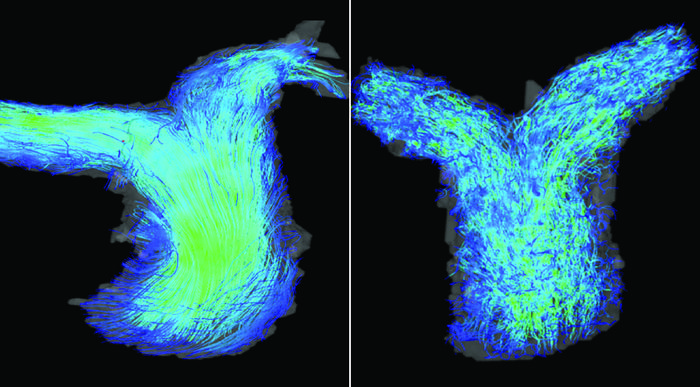4D flow cardiac MRI images of the pulmonary artery in patients with HFpEF. Left: a patient with normal right ventricle function shows laminar blood flow in the pulmonary artery. Right: a patient with right ventricle dysfunction experiencing turbulent blood flow in the artery.