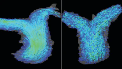 4D flow cardiac MRI images of the pulmonary artery in patients with HFpEF. Left: a patient with normal right ventricle function shows laminar blood flow in the pulmonary artery. Right: a patient with right ventricle dysfunction experiencing turbulent blood flow in the artery.