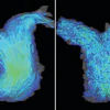 4D flow cardiac MRI images of the pulmonary artery in patients with HFpEF. Left: a patient with normal right ventricle function shows laminar blood flow in the pulmonary artery. Right: a patient with right ventricle dysfunction experiencing turbulent blood flow in the artery.