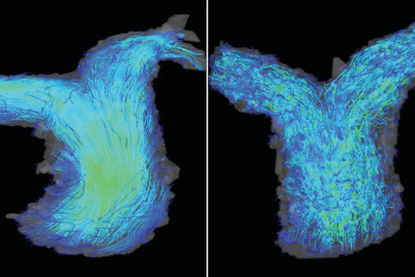 4D flow cardiac MRI images of the pulmonary artery in patients with HFpEF. Left: a patient with normal right ventricle function shows laminar blood flow in the pulmonary artery. Right: a patient with right ventricle dysfunction experiencing turbulent blood flow in the artery.