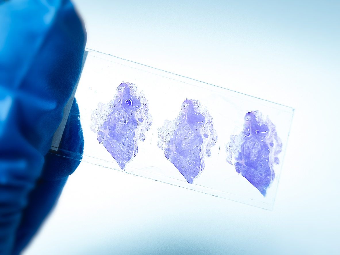 Three purple-stained histological tissue samples on a microscope slide held against light background