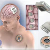 Paradomics brain implant technology illustration showing neural electrode placement, device components, and surgical instruments