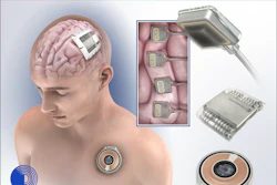 Paradomics brain implant technology illustration showing neural electrode placement, device components, and surgical instruments