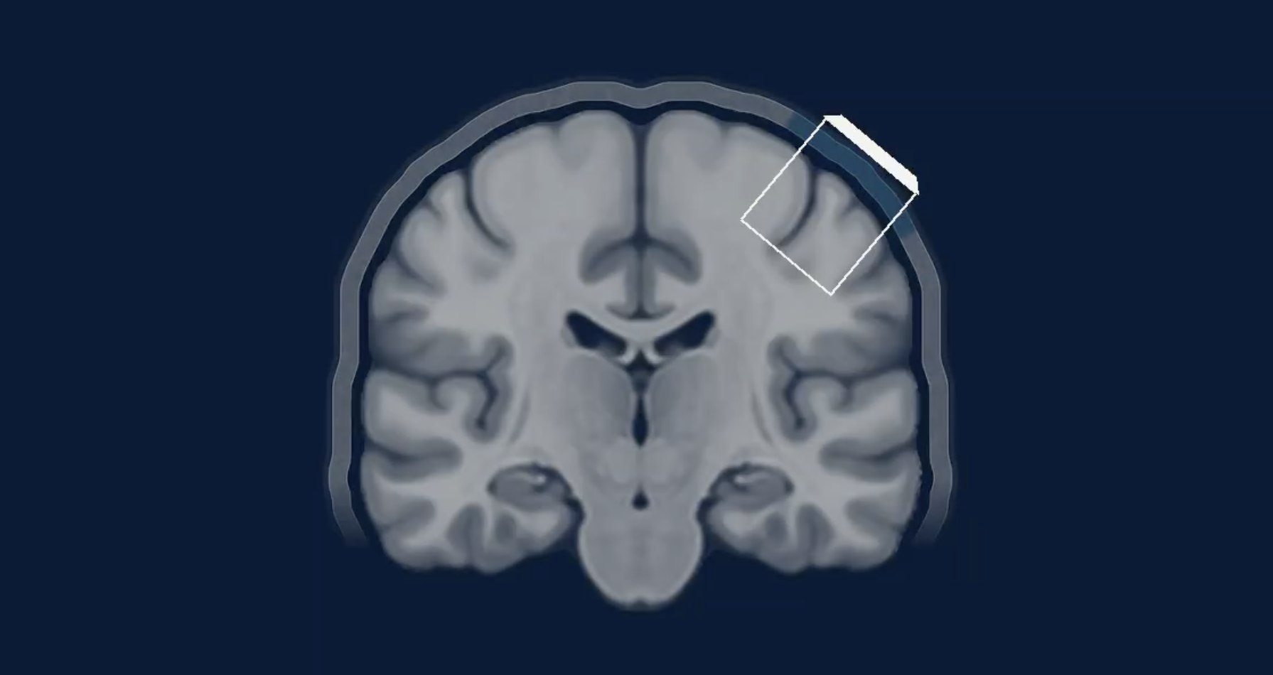 Coronal MRI brain scan showing anatomical structures with a smartphone icon overlay on the upper right