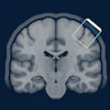 Coronal MRI brain scan showing anatomical structures with a smartphone icon overlay on the upper right