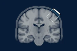 Coronal MRI brain scan showing anatomical structures with a smartphone icon overlay on the upper right