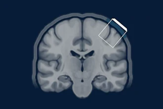 Coronal MRI brain scan showing anatomical structures with a smartphone icon overlay on the upper right