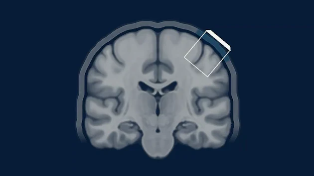Coronal MRI brain scan showing anatomical structures with a smartphone icon overlay on the upper right