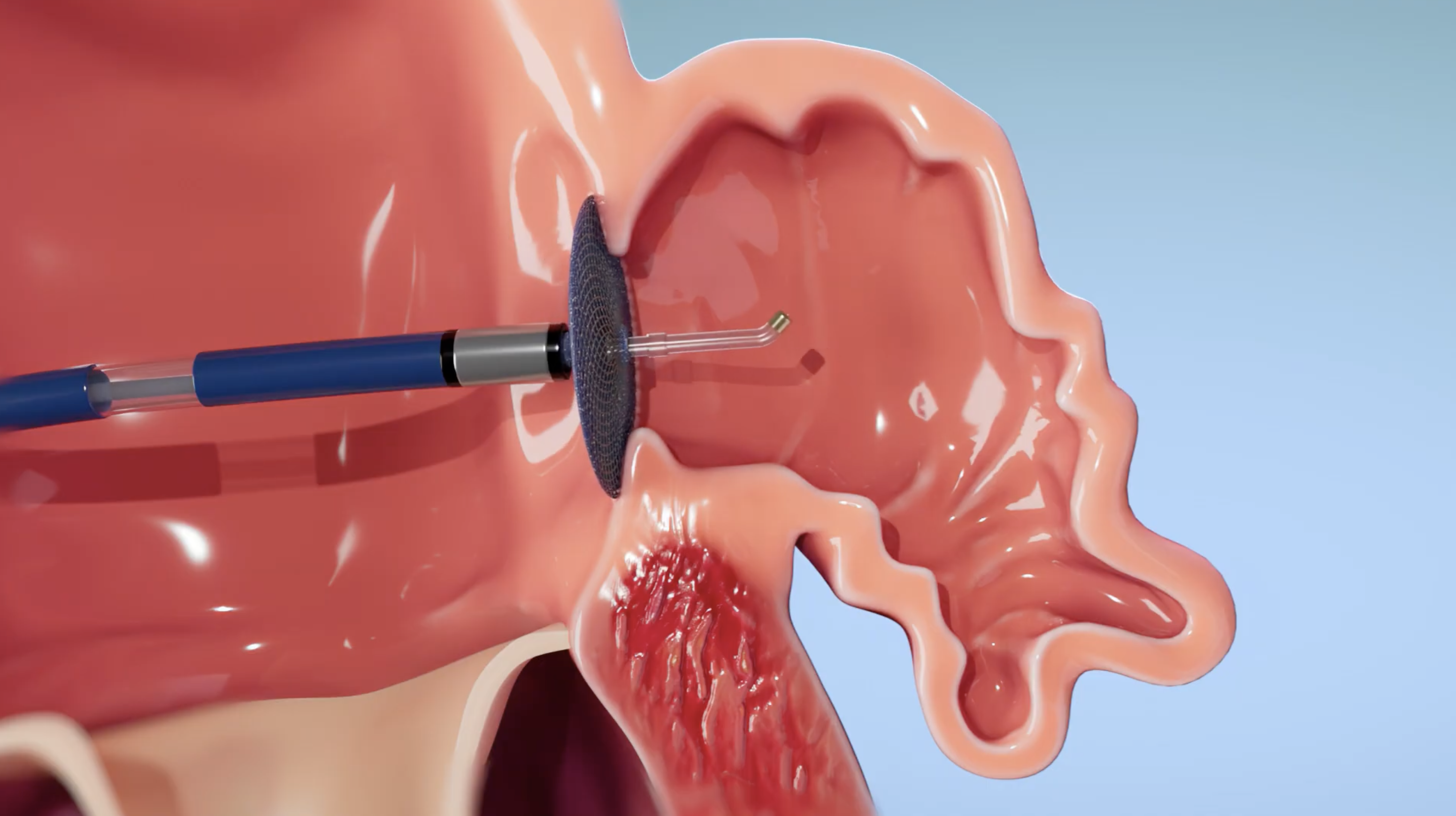 3D medical illustration of dental surgical procedure using a rotating burr instrument on oral tissue