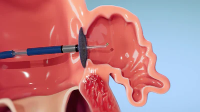 3D medical illustration of dental surgical procedure using a rotating burr instrument on oral tissue