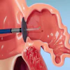 3D medical illustration of dental surgical procedure using a rotating burr instrument on oral tissue