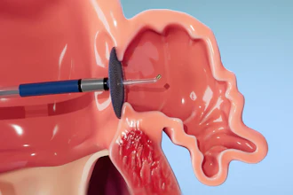 3D medical illustration of dental surgical procedure using a rotating burr instrument on oral tissue