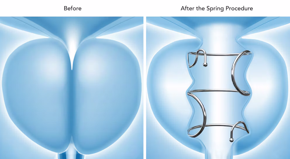 Before and after comparison of spring procedure showing anatomical structures with medical device placement
